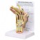 Modelo de mano con artritis reumatoide