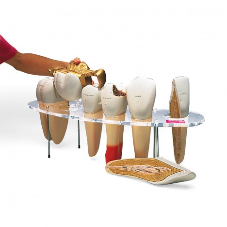Modelo de prótesis dental, 7 piezas, 10 veces su tamaño natural - Inglés
