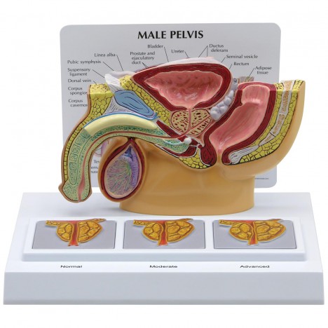Pelvis masculina con imágenes de próstata en 3D