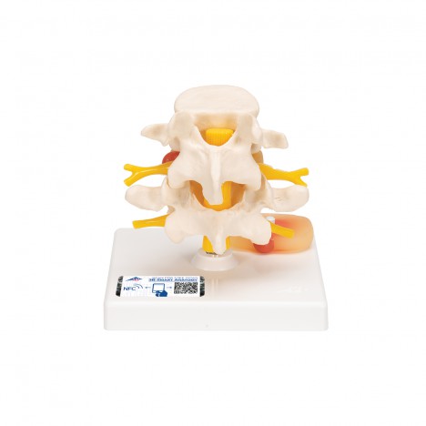 Discos vertebrales lumbares con hernia discal - 3B Smart Anatomy