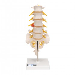 Colonne lombaire avec hernie discale dorsolatérale - 3B Smart Anatomy