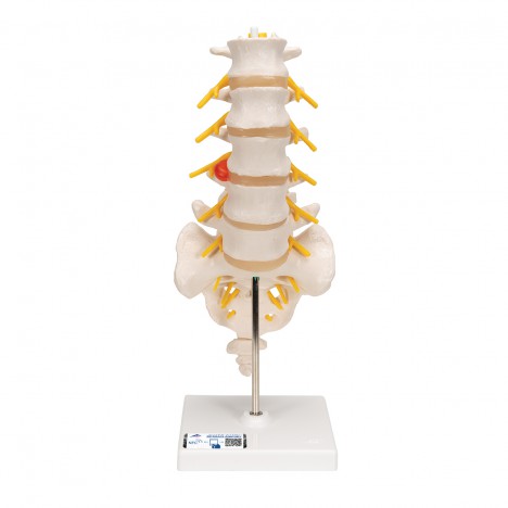 Columnavertebral lumbar con hernia discal dorsolateral - 3B Smart Anatomy