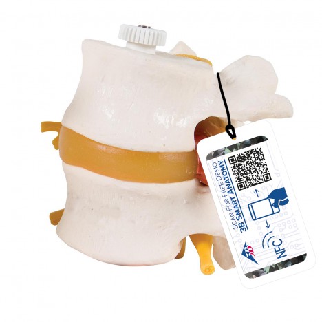 Discos lumbares, con hernia discal. Montados flexibles sobre soporte - 3B Smart Anatomy