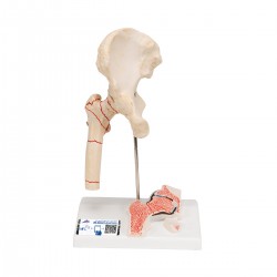 Fractura de fémur y desgaste de la articulación de la cadera - 3B Smart Anatomy