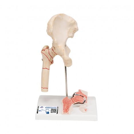 Fracture du fémur et usure de l'articulation de la hanche - 3B Smart Anatomy