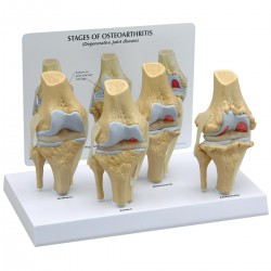 Conjunto de modelo de rodilla osteoartrítica, 4 fases