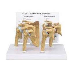 Modelo de hombro con osteoartritis (OA), 4 fases