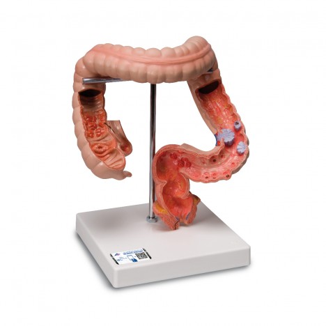 Enfermedades del tracto intestinal - 3B Smart Anatomy