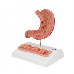 Estomac avec ulcères gastriques - 3B Smart Anatomy