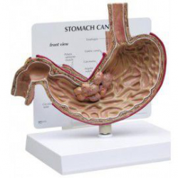 Modelo de cáncer de estómago
