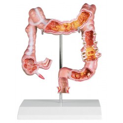 Modèle de colon avec maladies