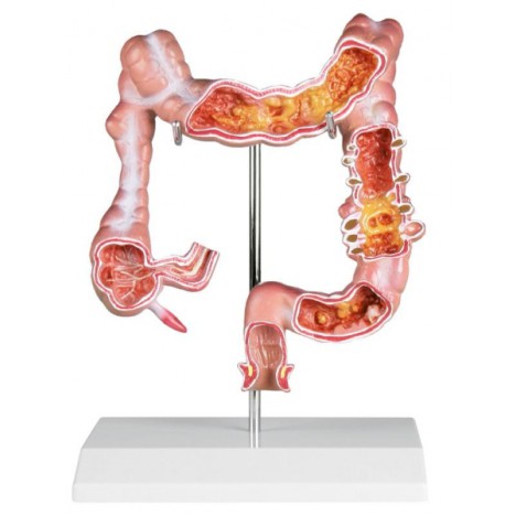 Modelo de colon con enfermedades